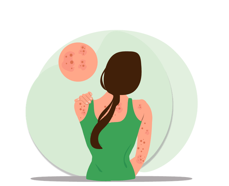 Psoriasis banner